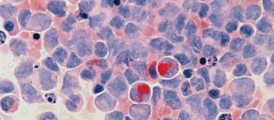 Learn About Acute Myeloid Leukaemia