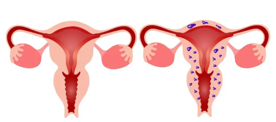 Adenomyosis: Symptoms, Causes, and Treatments