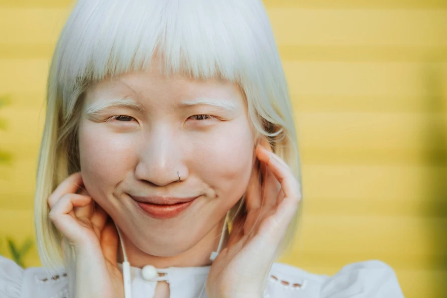Albinism: Symptoms, Causes, Types, and Treatment Strategies