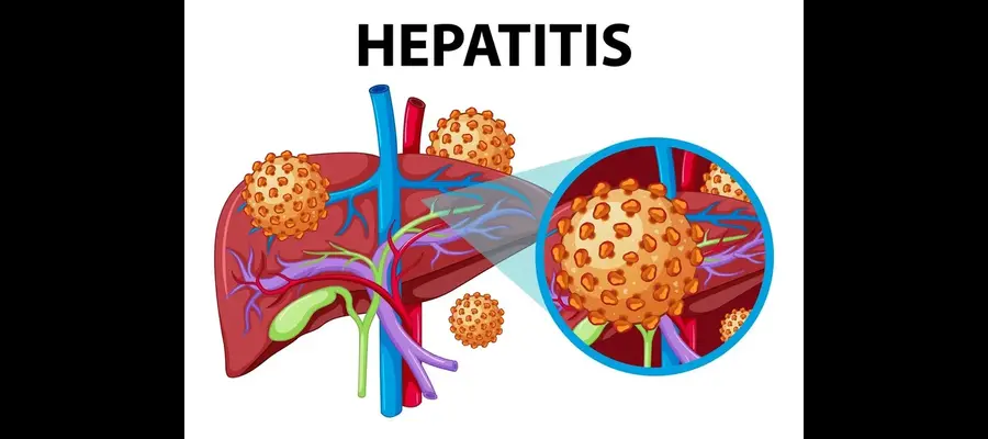 Alcoholic Hepatitis: Causes, Symptoms, and Diagnosis