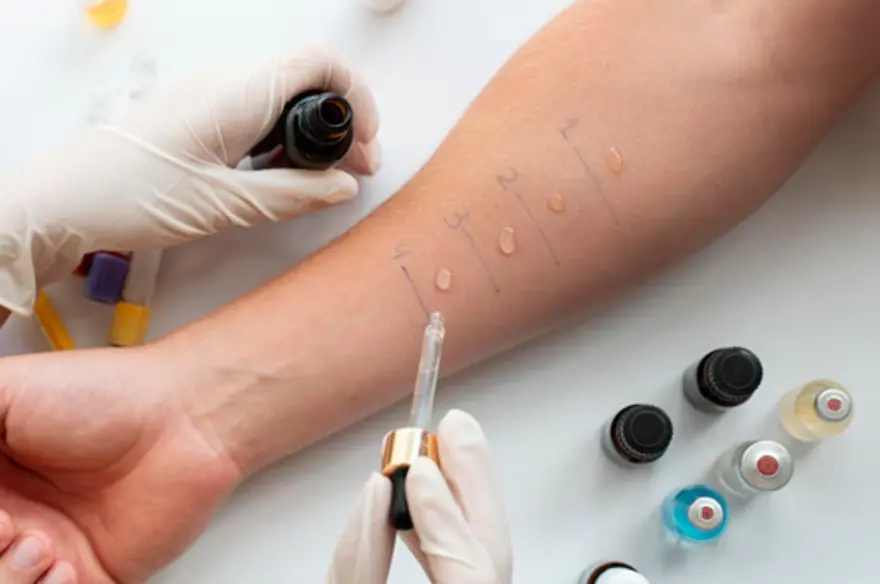 Allergy Skin Testing: Know What's Causing Your Reactions