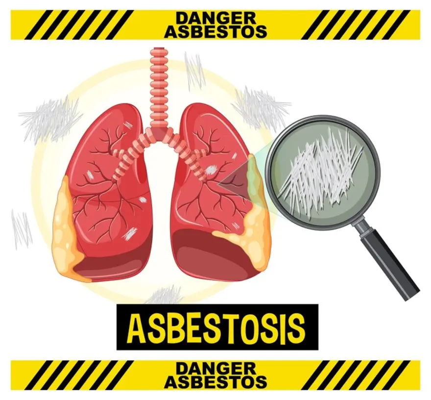 Asbestosis: Understanding the Long-Term Effects of Asbestos Exposure