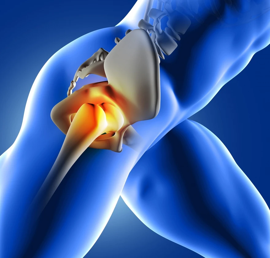 Exploring Avascular Necrosis (Osteonecrosis): Symptoms Causes, and Treatment