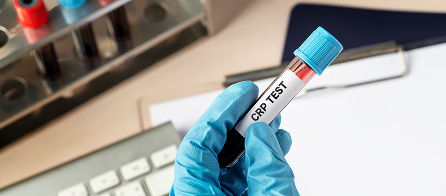 CRP Test (C Reactive Protein) in COVID-19: All You Need to Know