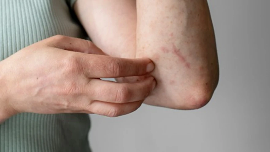 Bee Stings: Immediate First Aid, Allergic Reactions & Treatment