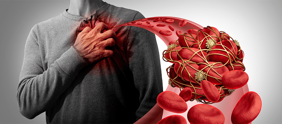Blood Clotting Disorders: Types, Causes, Symptoms, Diagnosis, And Treatment