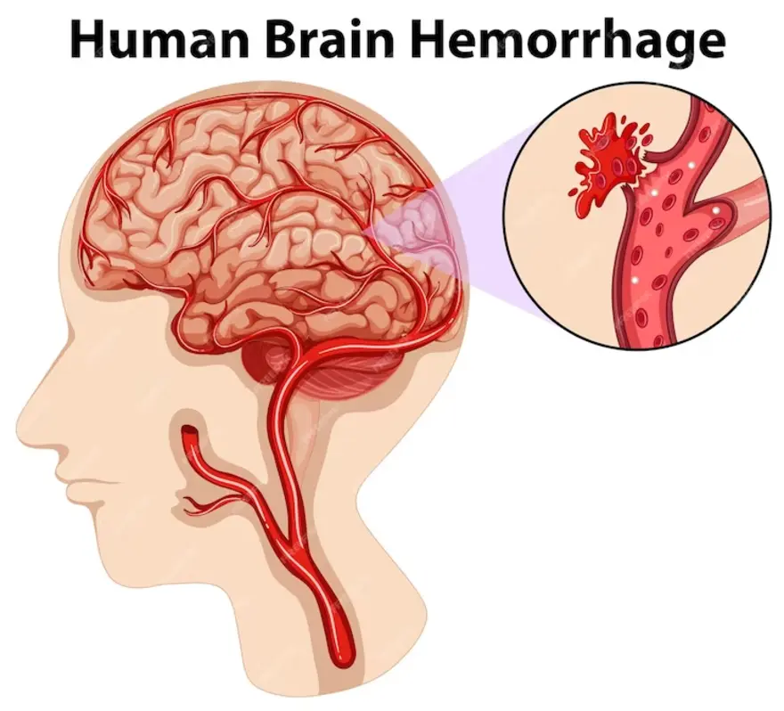 Brain Hemorrhage in Hindi - ????? ?????? ?? ?????: ?????, ????, ????? ?? ??????
