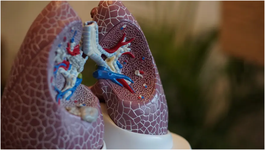 Bronchiectasis: Know More About This Lung Infection
