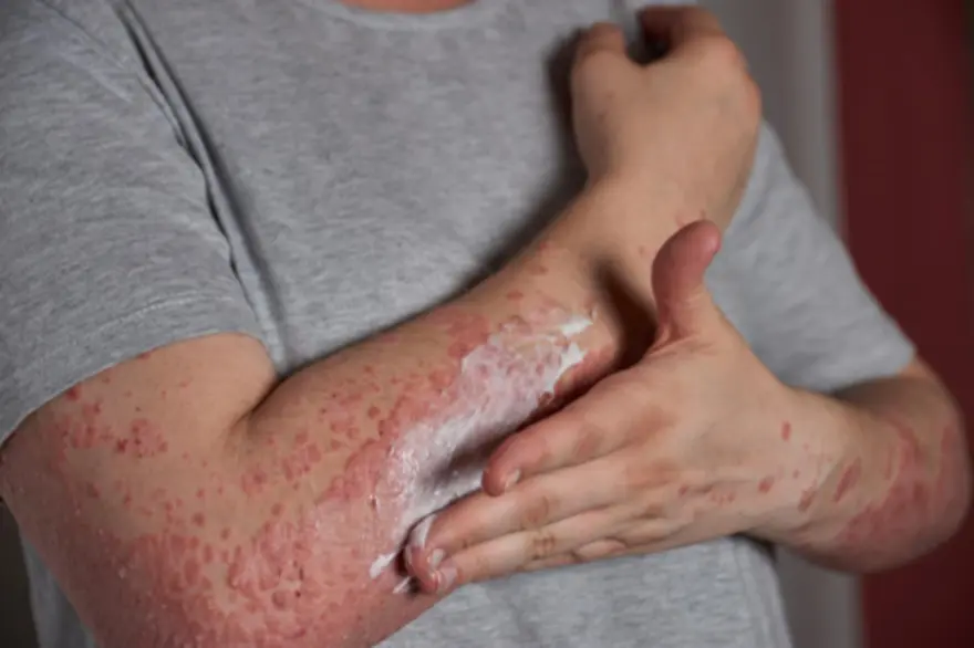 Bullous Pemphigoid: Symptoms, Causes & Treatment
