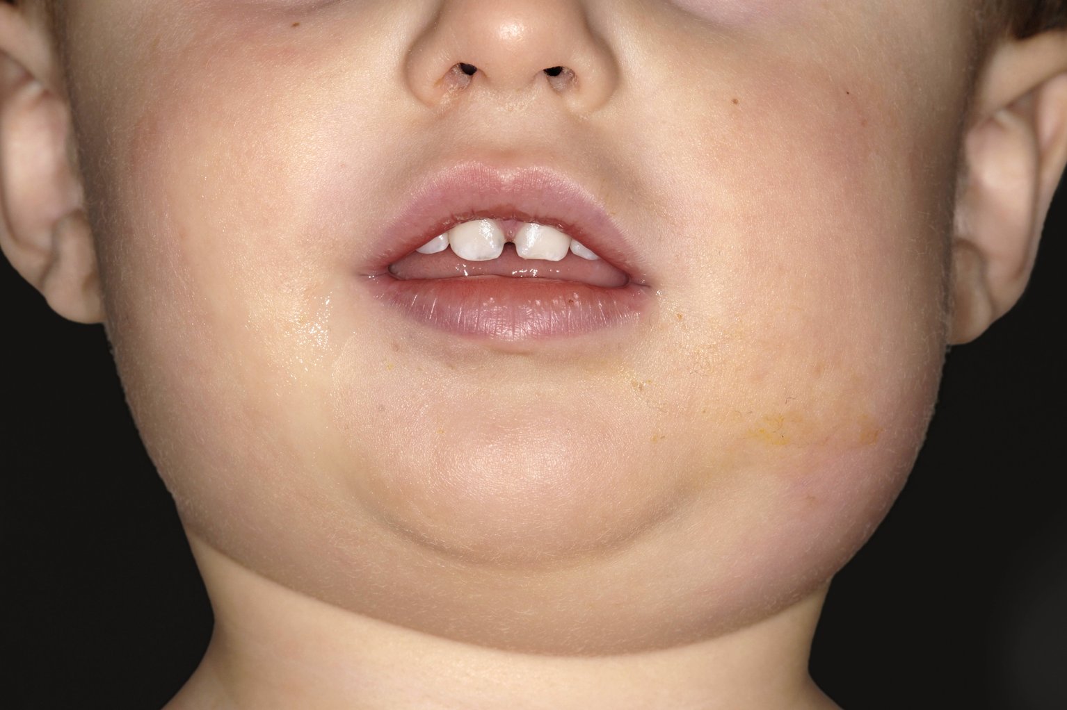 What You Need to Know About Mumps and How to Protect Yourself