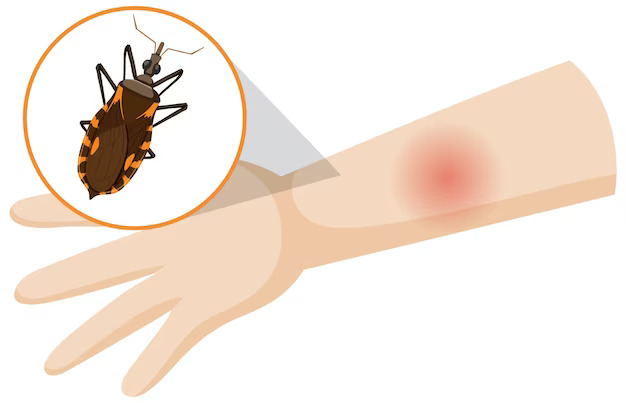 Chagas Disease: Symptoms, Causes, Treatment & Genetic Testing