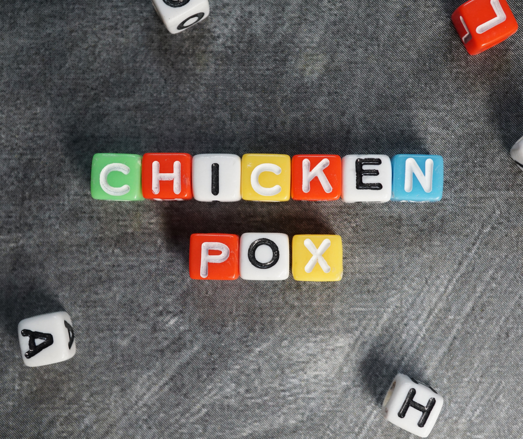 Managing Chickenpox Symptoms - Metropolis Expert Explains