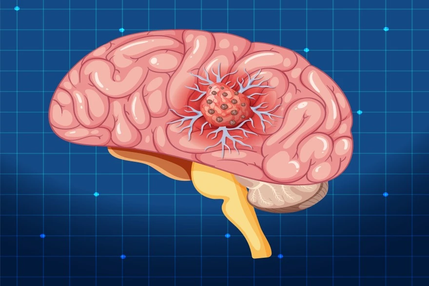 Choroid Plexus Tumor: Symptoms, Diagnosis & Treatment