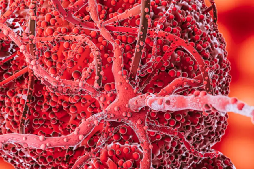 Chronic Lymphocytic Leukaemia: What You Need to Know