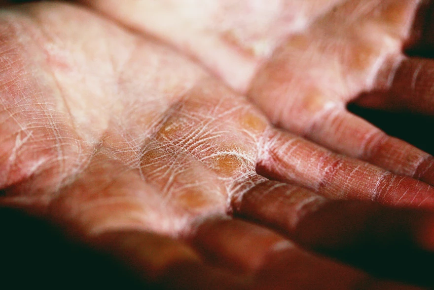 Dyshidrosis Eczema (Dyshidrosis): Symptoms, Triggers & Treatment Options