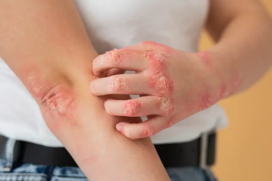 Living with Epidermolysis Bullosa: Insights and Care Tips