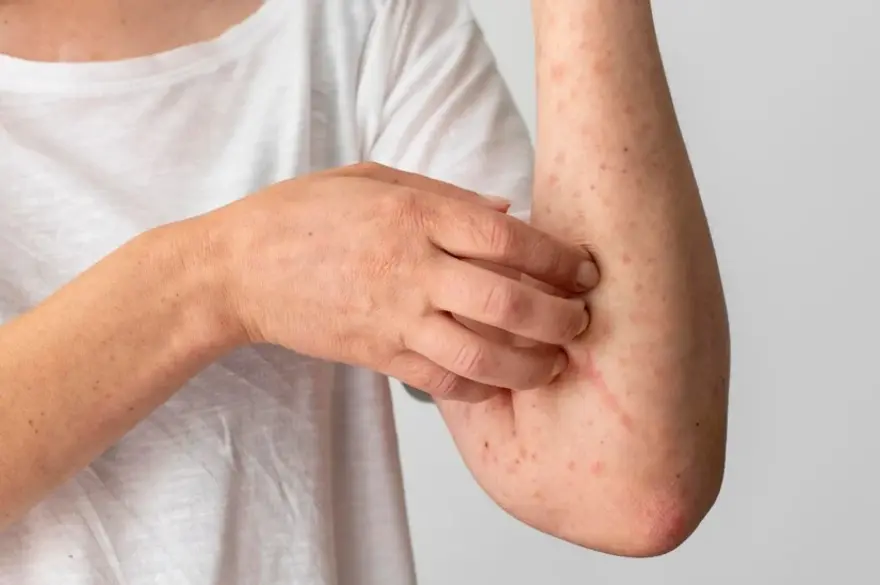 Erythema Nodosum: Symptoms, Causes, and Treatment for Skin Inflammation