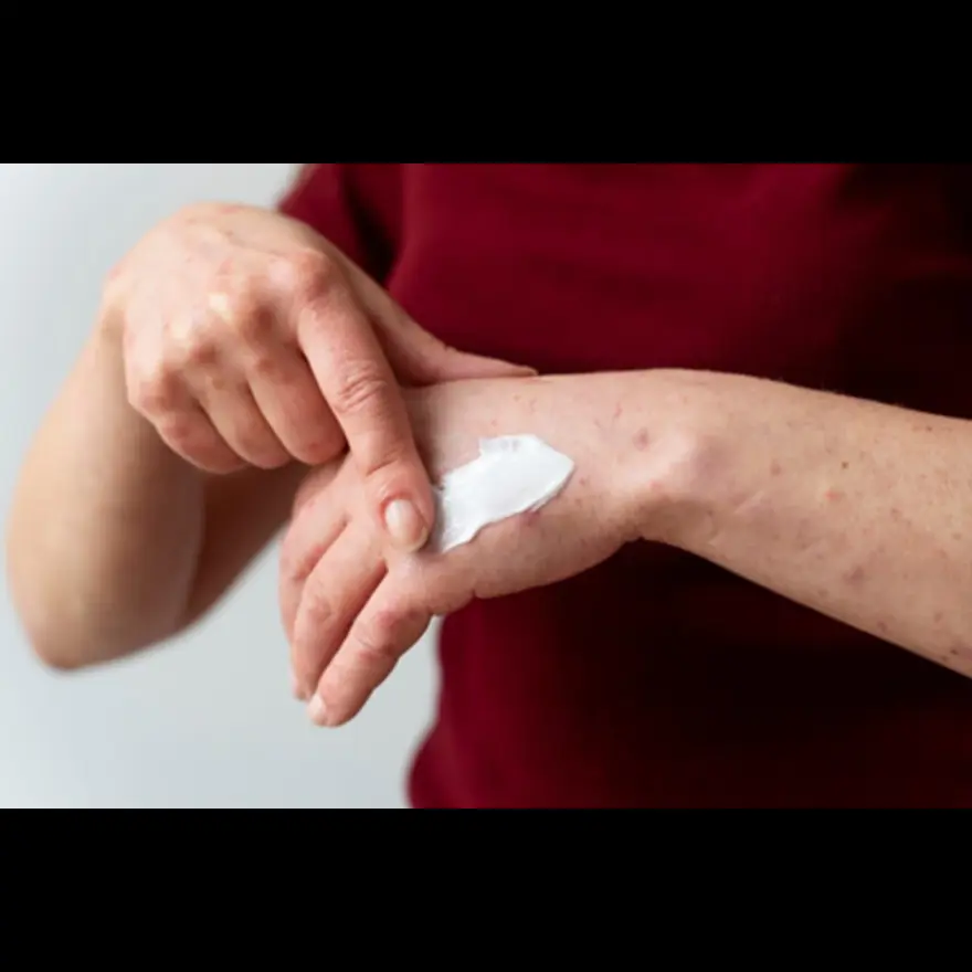 Essential Summer Skin Care Tips to Prevent Heat Rash and Sunburn