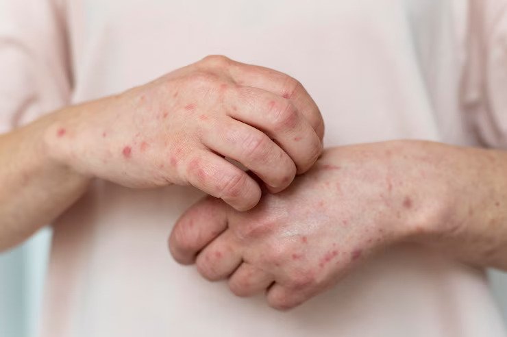 Still's Disease - Symptoms, Causes And Treatment
