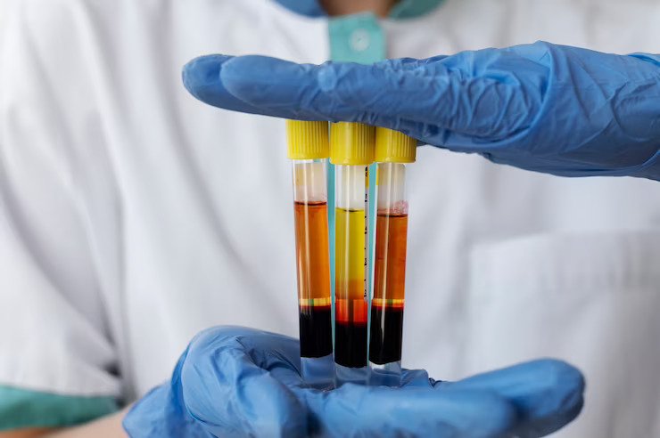 Gamma-Glutamyl Transferase (GGT) Test: Normal Range, Procedure & Result