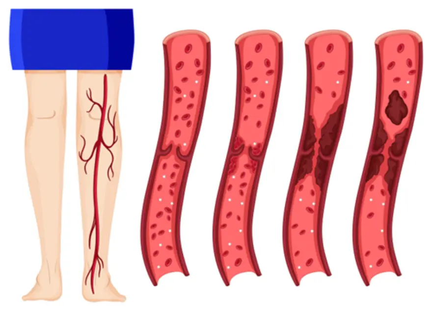 Factor V Leiden Genetic Mutation: What It Means, Risks & How to Manage It
