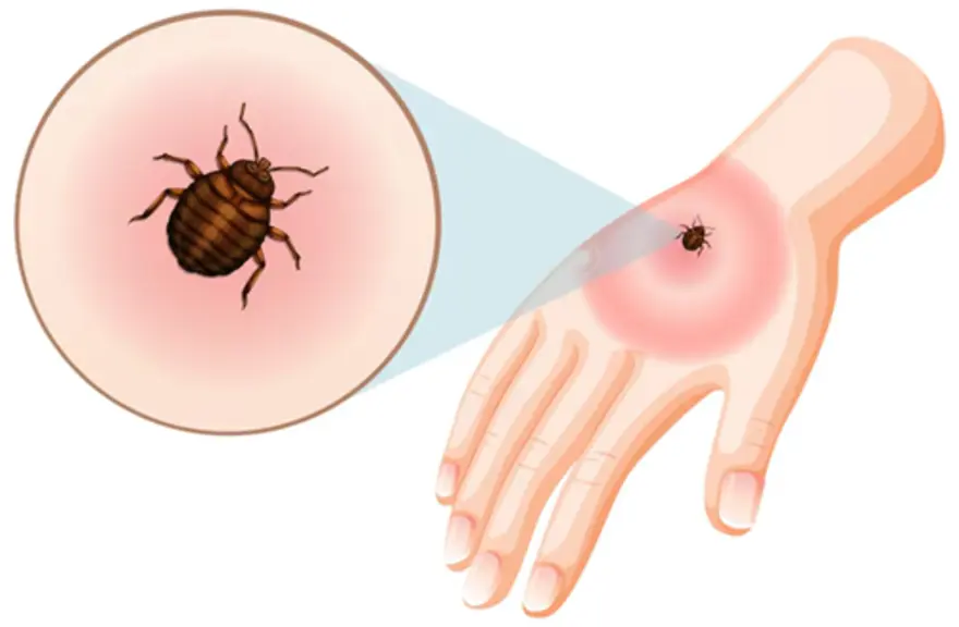 Scrub Typhus: Symptoms, Treatment, Prevention & Key Facts