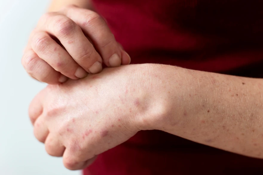 Folliculitis: Symptoms, Causes, and Treatment Approaches