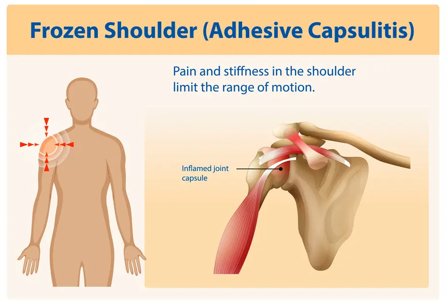 Frozen Shoulder: How to Recognise and Manage the Pain