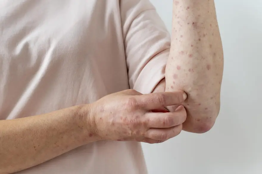 Fungal Skin Infections: Causes, Symptoms, Treatment, and Prevention Tips