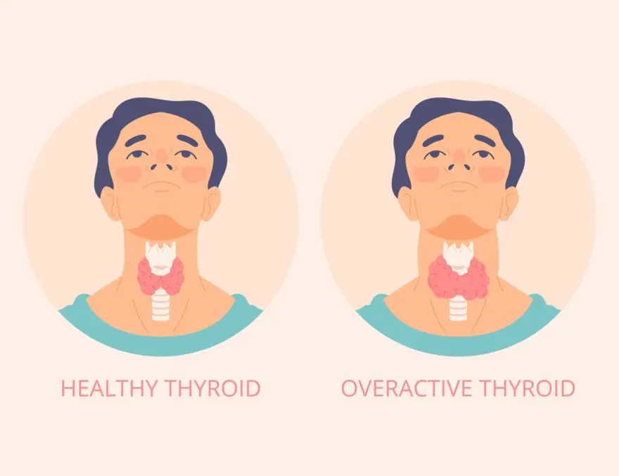 What You Need to Know About Goiter