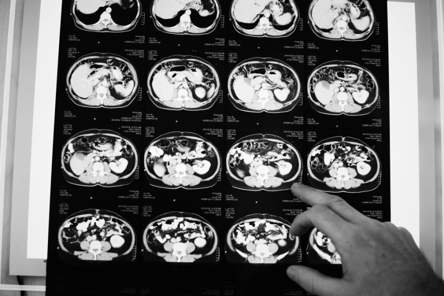Hemangioblastoma: Causes, Symptoms & Latest Research