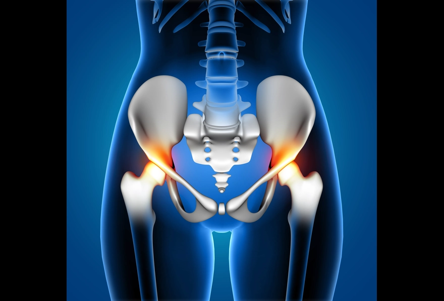 Hip Dysplasia: Causes, Symptoms, and Treatment
