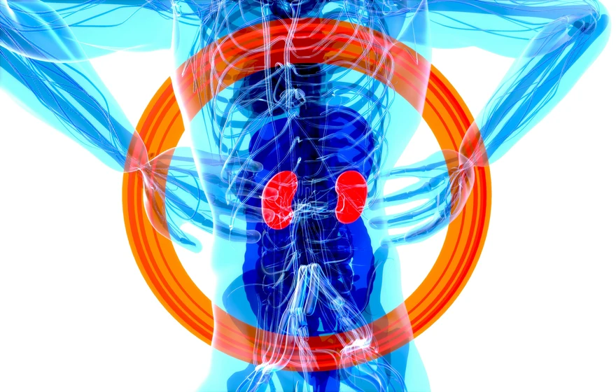 Home Remedies for Kidney Stones: Relief & Prevention Tips