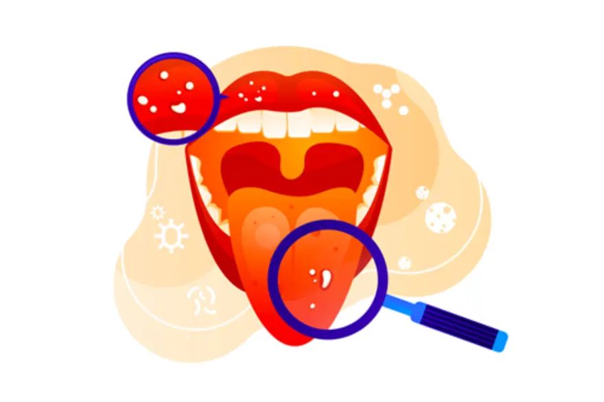Home Remedies for Mouth Ulcers: Fast Relief & Why They Appear