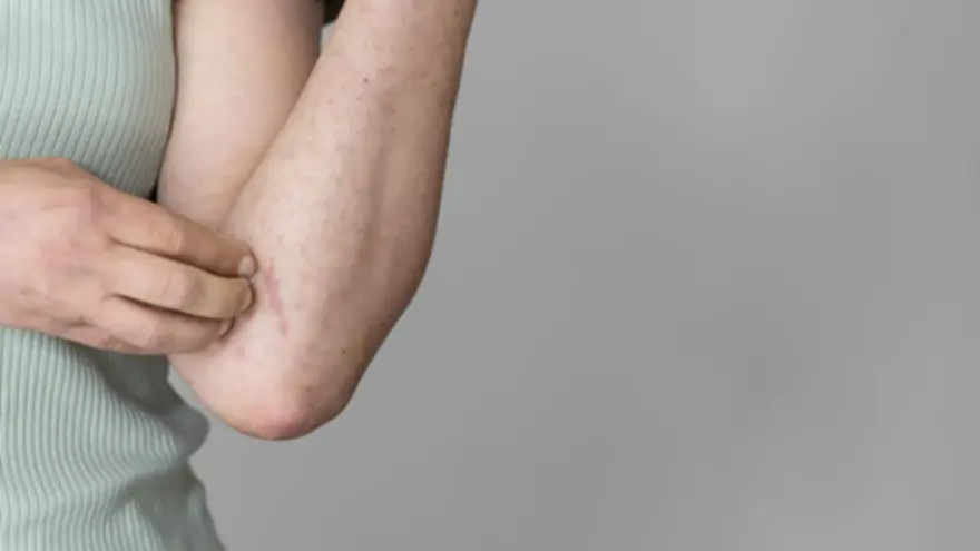 Kaposi Sarcoma: Understanding Symptoms & Treatment Options