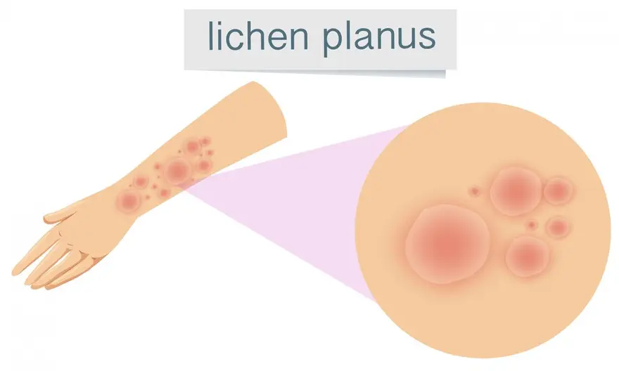 Know About Lichen Planus: Symptoms, Causes, Treatment and Diagnosis
