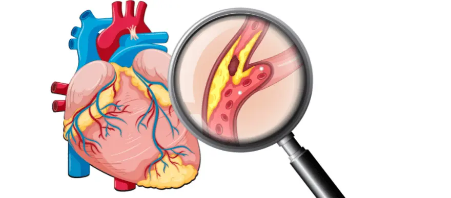 Lipid Disorders: What Are They And How Can I Treat Them?