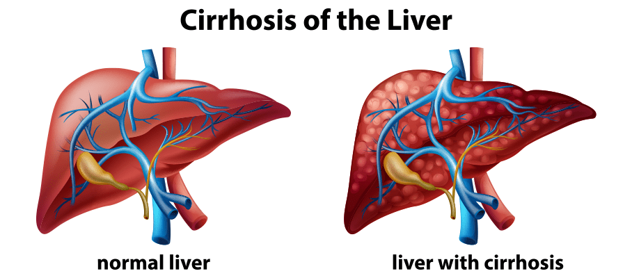 Liver Cirrhosis: Symptoms, Tests and Treatment