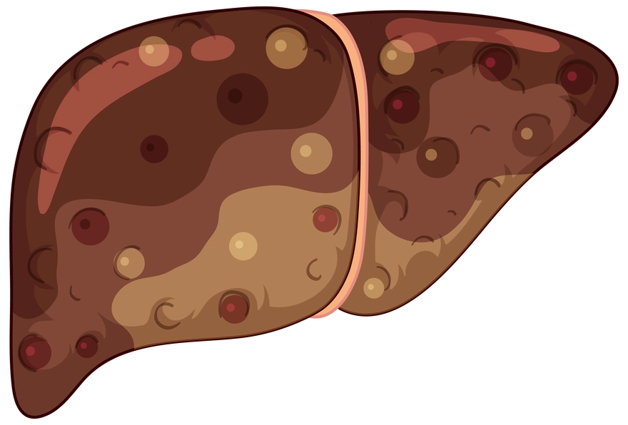 Liver Fibrosis: Causes, Symptoms, Stages & Treatment Explained