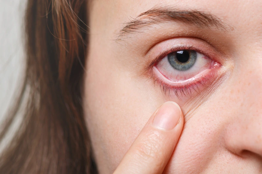 Exploring Conjunctivitis Causes and Risk Factors: In-Depth Analysis