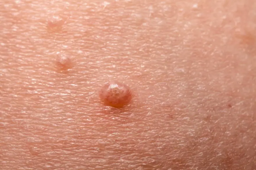 All You Need To Know About Molluscum Contagiosum