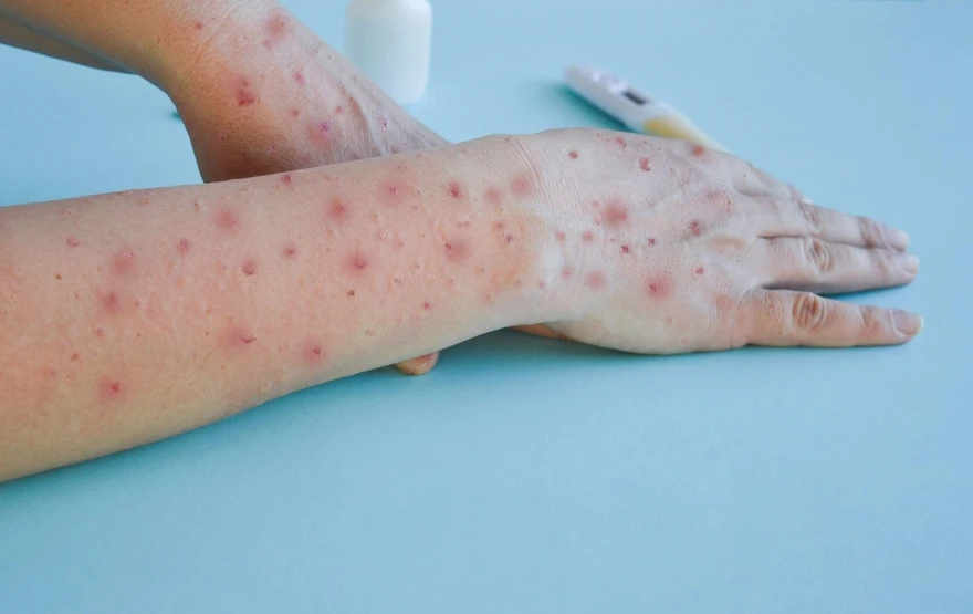 Monkeypox (Mpox): Symptoms, Causes, Treatment, Spread & Prevention Guide