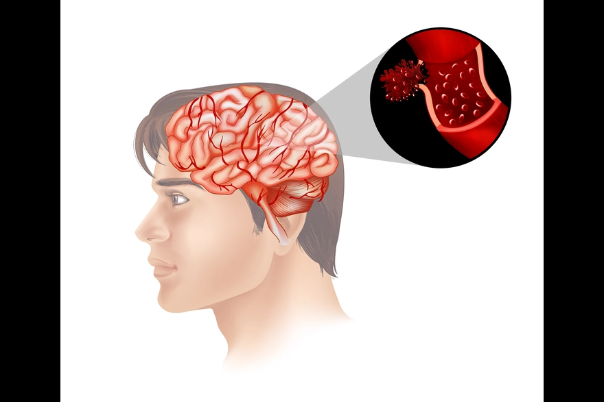 Moyamoya Disease: Understanding This Rare Brain Condition