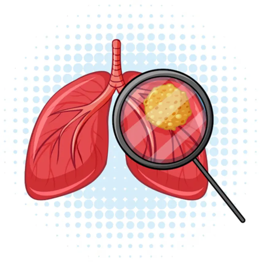 A Complete Guide to Neuroendocrine Tumours: What You Need to Know