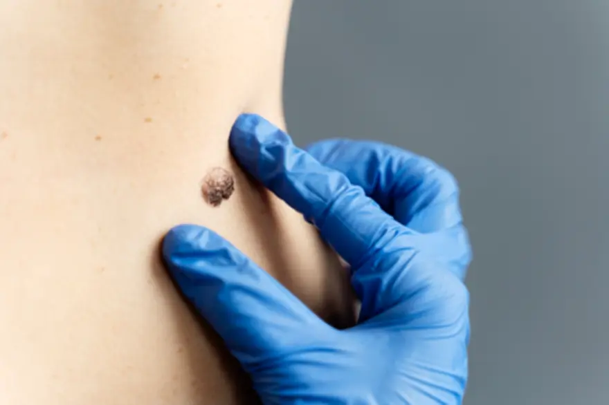Neurofibroma: What It Is, When to Get It Checked & Possible Treatments
