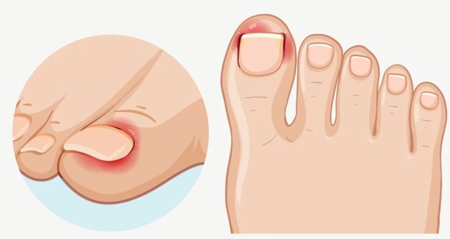 Onychomycosis (Nail Fungus): Symptoms, Causes & Treatment
