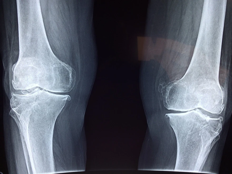 Understanding Osteomyelitis (Bone Infection): Symptoms, Causes, and Treatment