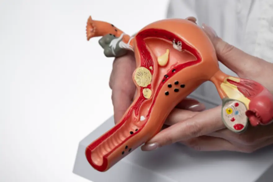 PCOS (Polycystic Ovary Syndrome): Everything You Need to Know