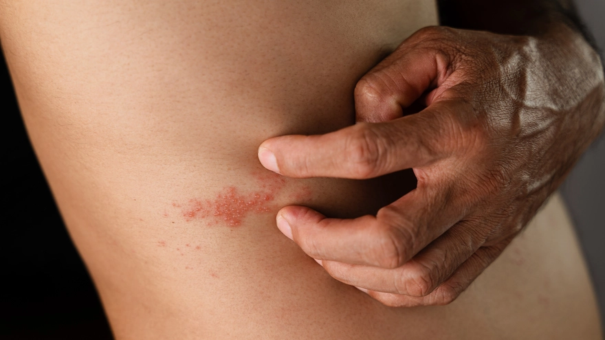 Pemphigus Vulgaris: An In-Depth Look at Symptoms and Treatment Options