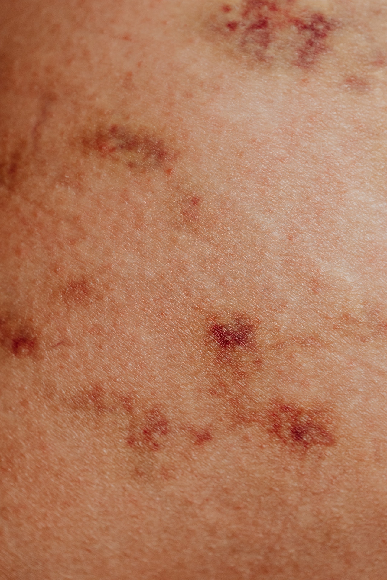Neurofibromatosis: Types, Symptoms and Treatment Options
